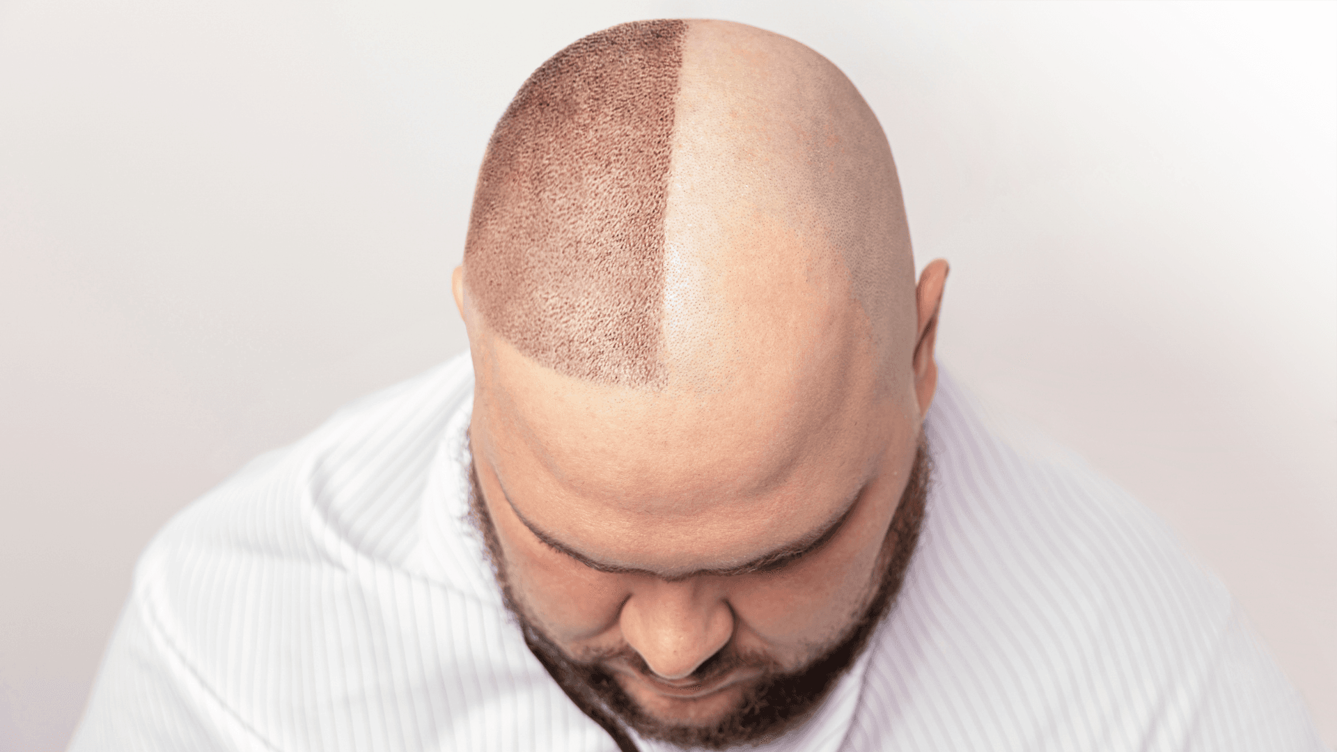 What is Hair Patch? A Complete Guide to Non-Surgical Hair Replacement